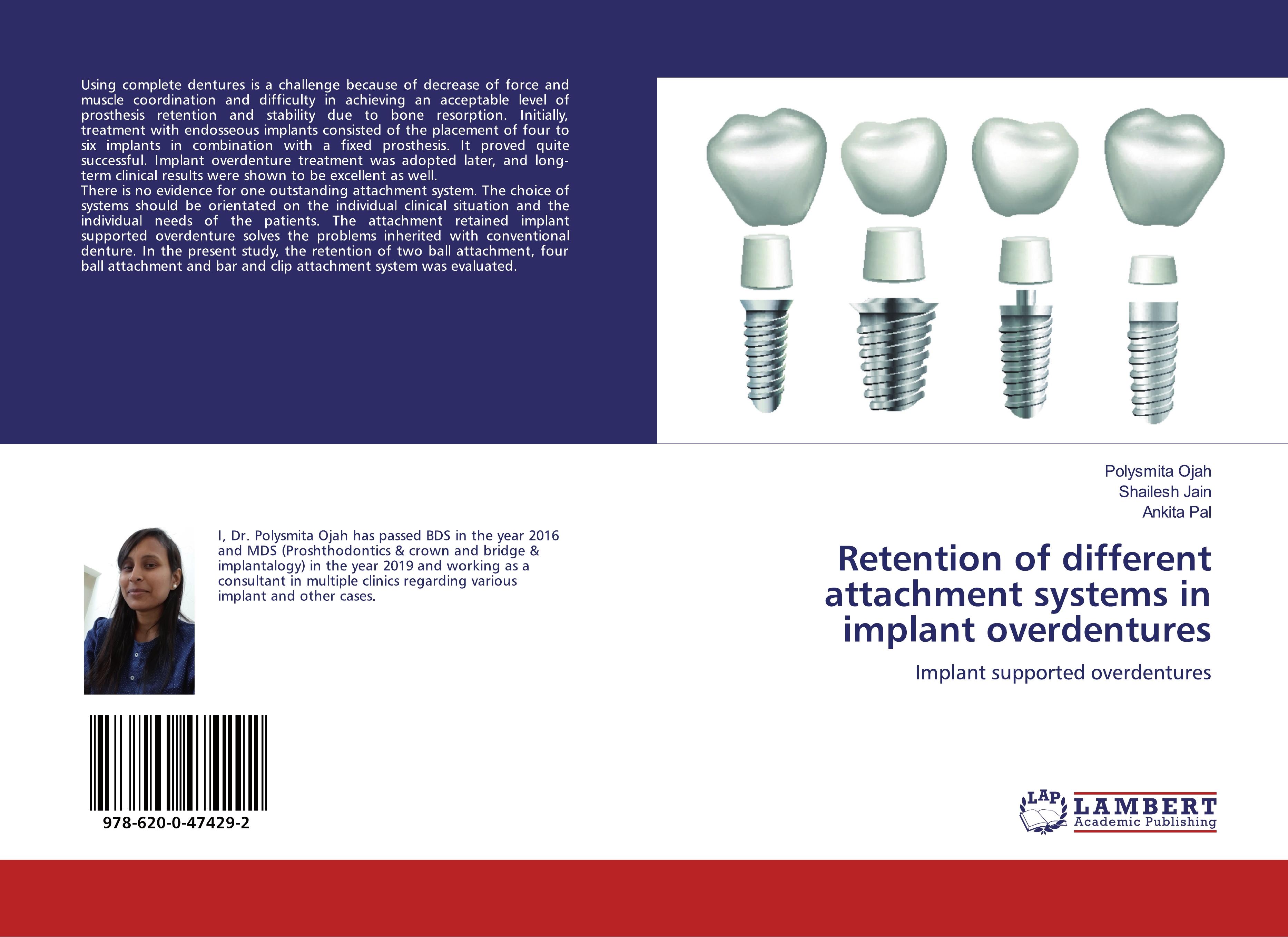 Retention of different attachment systems in implant overdentures