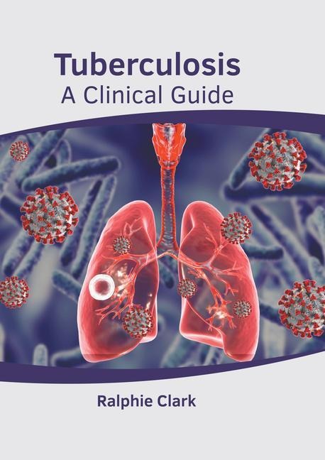 Tuberculosis