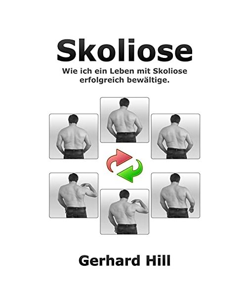 Skoliose